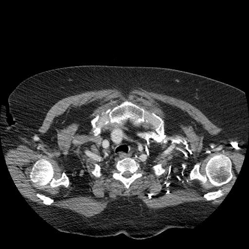 Bovine aortic arch - right internal mammary vein drains into the superior vena cava (Radiopaedia 63296-71875 A 16).jpg
