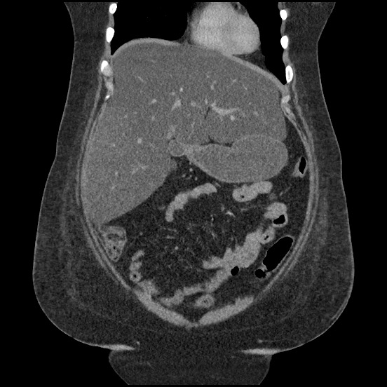 Bowel and splenic infarcts in acute lymphocytic leukemia (Radiopaedia 61055-68913 B 21).jpg