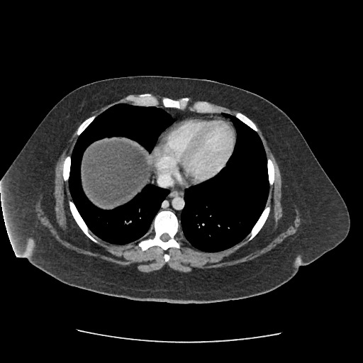 File:Bowel and splenic infarcts in acute lymphocytic leukemia (Radiopaedia 61055-68915 A 14).jpg