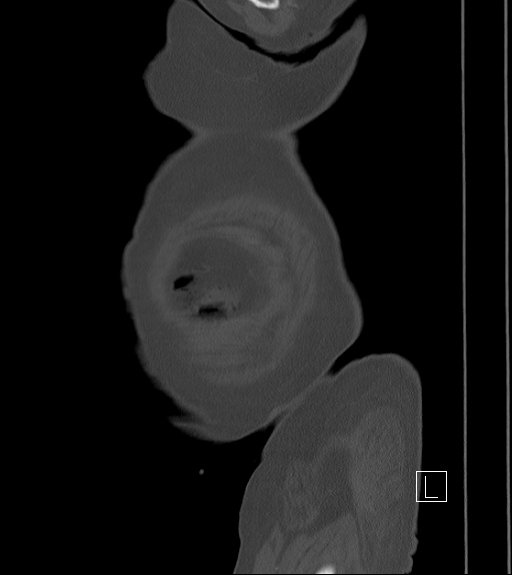 Bowel ischemia secondary to SMA occlusion with extensive portomesenteric venous gas (Radiopaedia 54656-60871 Sagittal bone window 114).jpg