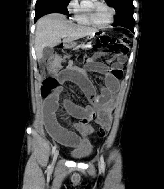 Bowel obstruction from colon carcinoma (Radiopaedia 22995-23028 C 22).jpg