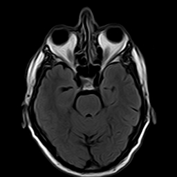 File:Brain abscess complicated by intraventricular rupture and ventriculitis (Radiopaedia 82434-96571 Axial FLAIR 7).jpg