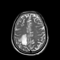 File:Brain abscess complicated by intraventricular rupture and ventriculitis (Radiopaedia 82434-96571 Axial T2 19).jpg