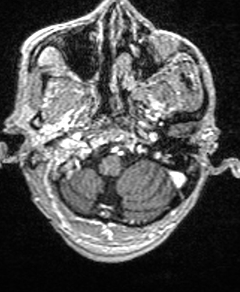 Brain abscess with dual rim sign (Radiopaedia 87566-103938 Axial T1 C+ 30).jpg