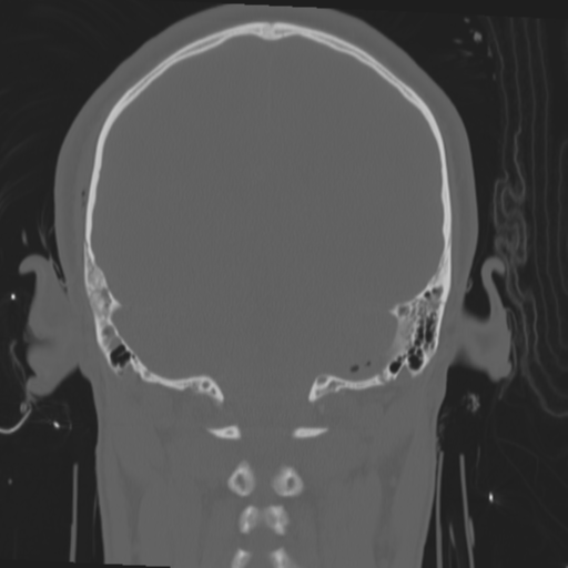 Brain contusions, internal carotid artery dissection and base of skull fracture (Radiopaedia 34089-35339 Coronal bone window 48).png