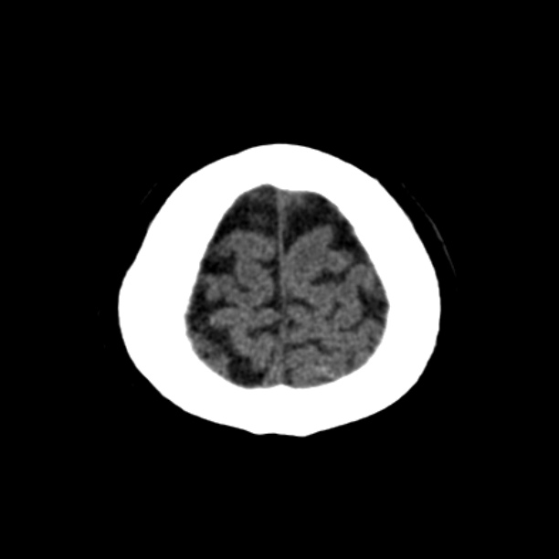 Brain cortical laminar necrosis (Radiopaedia 25822-25971 Axial non-contrast 44).jpg
