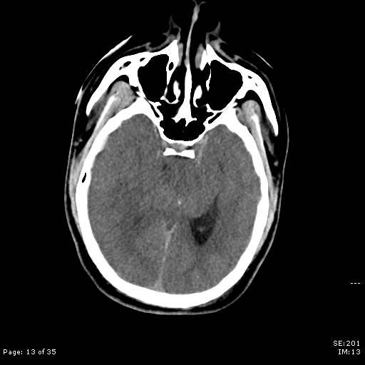 File:Brain death after motor vehicle collision (Radiopaedia 88470-105114 Axial non-contrast 13).jpg