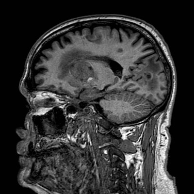 Brain metastases from lung cancer (Radiopaedia 83839-99028 Sagittal T1 48).jpg