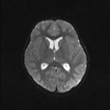 Brainstem glioma (Radiopaedia 67531-76922 Axial DWI 14).jpg