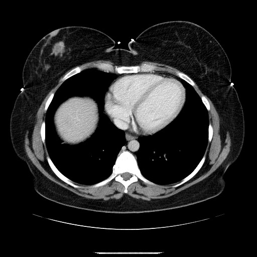 File:Breast cancer pseudocirrhosis after chemotherapy (Radiopaedia 65407-74456 Axial 43).jpg