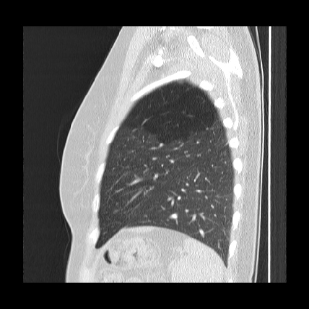 Bronchial atresia (Radiopaedia 22965-22992 Sagittal lung window 11).jpg