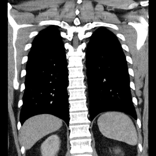 Bronchial carcinoid tumor (Radiopaedia 67377-76764 C 49).jpg
