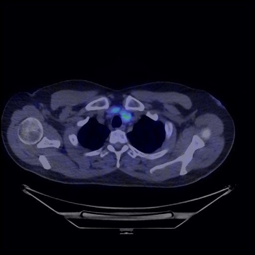 Bronchial carcinoid tumor (Radiopaedia 67377-76765 68Ga-DOTATATE PET-CT 19).jpg