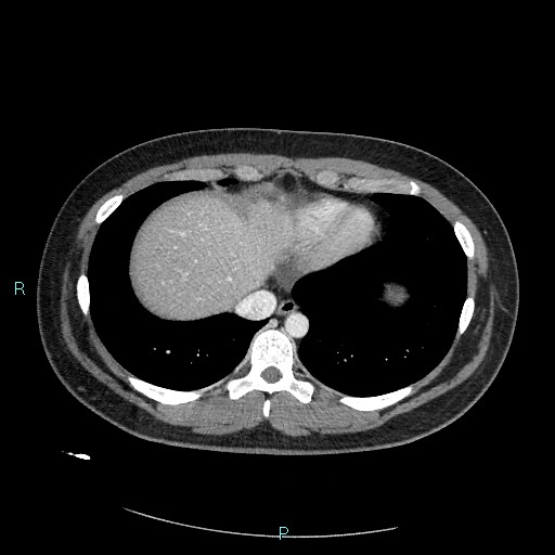 Bronchial carcinoid tumor (Radiopaedia 78272-90875 A 75).jpg