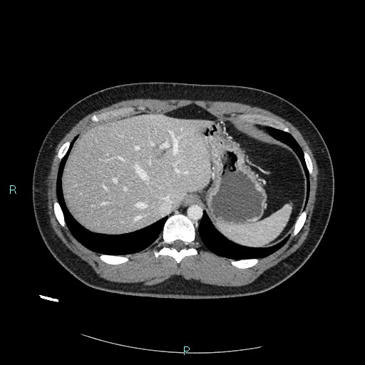 Bronchial carcinoid tumor (Radiopaedia 78272-90875 A 86).jpg