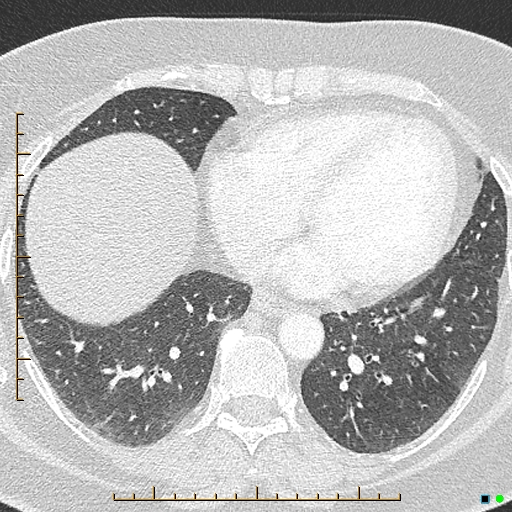 Bronchial diverticula (Radiopaedia 79512-92676 Axial lung window 145).jpg