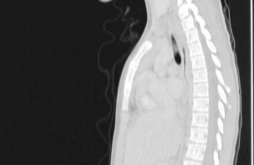 Bronchial mucoepidermoid carcinoma (Radiopaedia 57023-63895 Sagittal lung window 83).jpg
