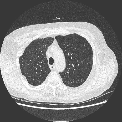 File:Bronchial stenosis - lung transplant (Radiopaedia 73133-83848 B 10).jpg