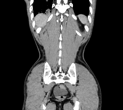 Bronchiectasis in Crohn disease (Radiopaedia 60311-67977 C 76).jpg
