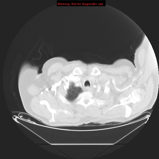 File:Bronchioloalveolar carcinoma (Radiopaedia 9272-9955 Axial lung window 2).jpg