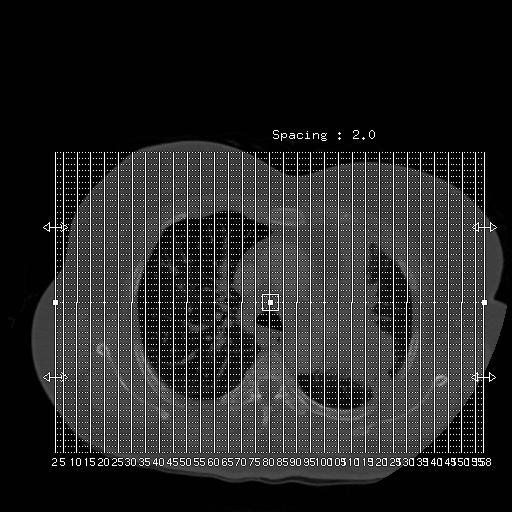 Bronchogenic carcinoma (Radiopaedia 73497-84262 Sagittal bone window 1).jpg