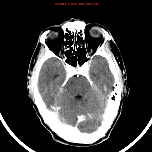 File:Bronchogenic carcinoma brain metastasis (Radiopaedia 9286-9970 B 9).jpg