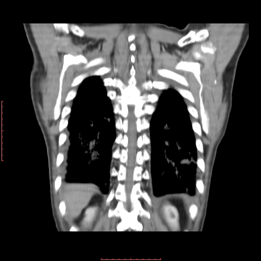 File:Bronchogenic carcinoma with left atrial large deposit - T4N3M1a (Radiopaedia 42316-45428 B 15).jpg