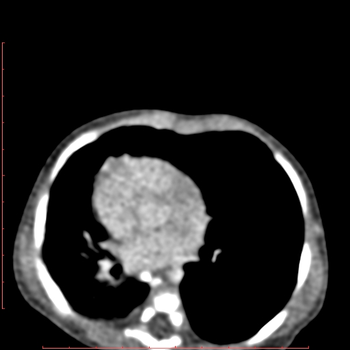Bronchogenic cyst (Radiopaedia 78599-91409 B 115).jpg