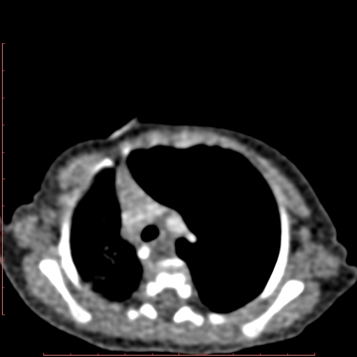 Bronchogenic cyst (Radiopaedia 78599-91409 B 68).jpg