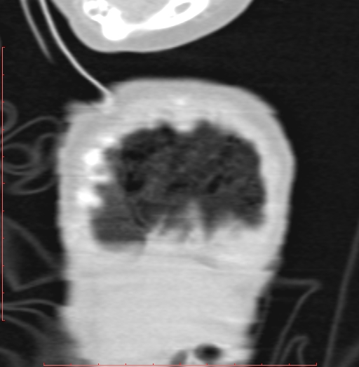 Bronchogenic cyst (Radiopaedia 78599-91409 Coronal lung window 17).jpg