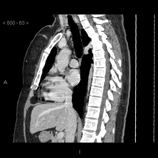 File:Bronchogenic cyst - posterior mediastinal (Radiopaedia 43885-47364 B 42).jpg