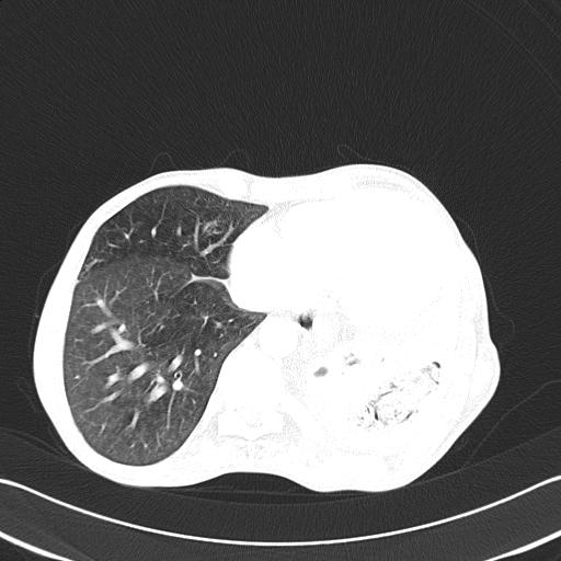 Bronchopleural fistula secondary to tuberculosis (Radiopaedia 20415-20322 Axial lung window 43).jpg