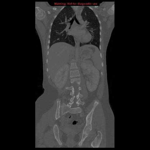 File:Brown tumor (Radiopaedia 12318-12596 D 40).jpg