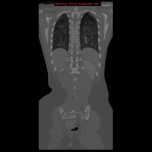 File:Brown tumor (Radiopaedia 12318-12596 D 52).jpg