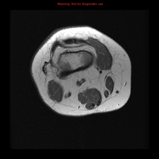 File:Brown tumor (Radiopaedia 12318-12597 Axial T1 1).jpg