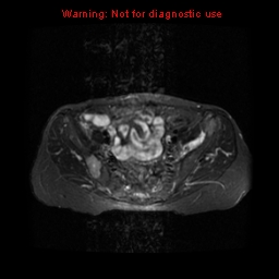File:Brown tumors (Radiopaedia 9666-10290 Axial T2 fat sat 11).jpg