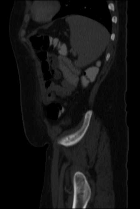 Brown tumors compressing the spinal cord (Radiopaedia 68442-77988 H 46).jpg