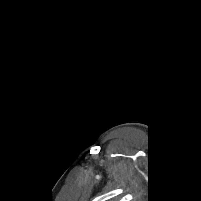 Buccal fat pad arteriovenous malformation (Radiopaedia 70936-81144 C 7).jpg