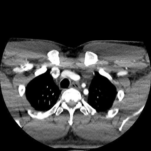 Buccal fat pad arteriovenous malformation (Radiopaedia 70936-81144 D 18).jpg