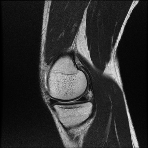 File:Bucket-handle meniscus tear (Radiopaedia 65700-74809 Sagittal T2 7).jpg
