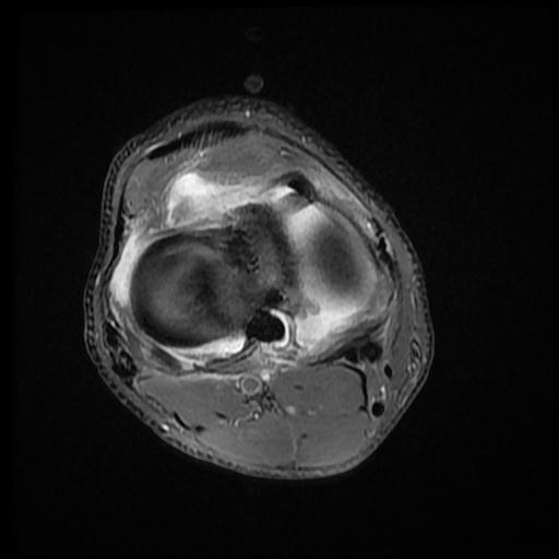 File:Bucket handle tear - medial meniscus (Radiopaedia 69245-79026 Axial PD fat sat 13).jpg