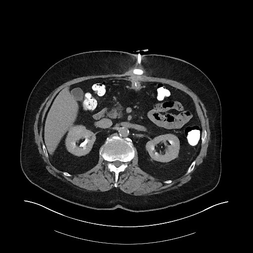 File:Buried bumper syndrome - gastrostomy tube (Radiopaedia 63843-72575 Axial Inject 8).jpg