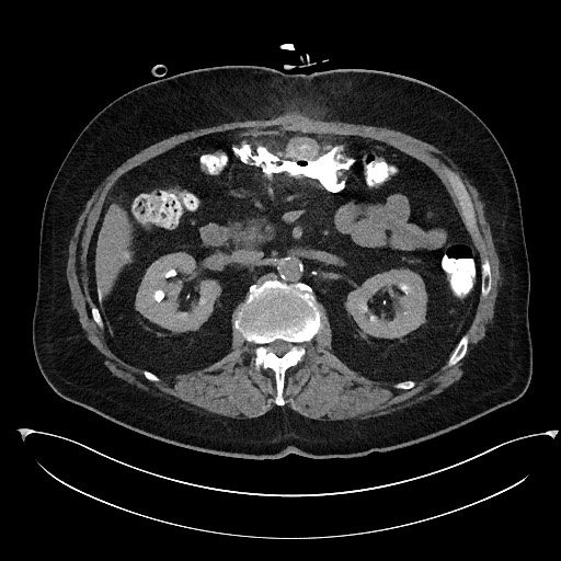 File:Buried bumper syndrome - gastrostomy tube (Radiopaedia 63843-72577 Axial Inject 39).jpg