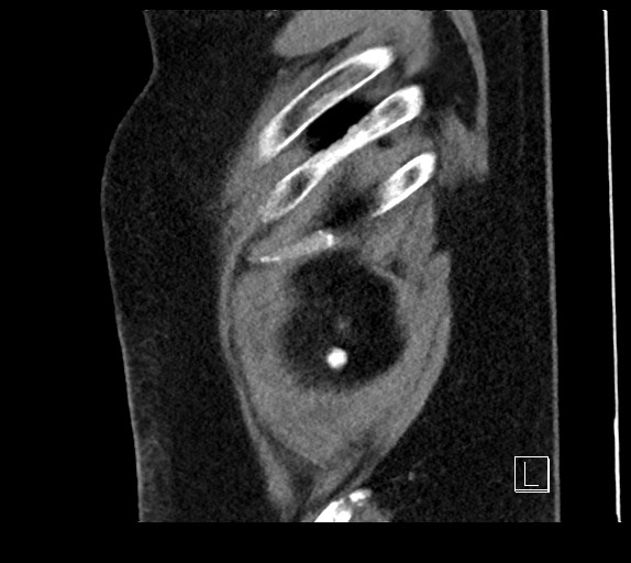 Buried bumper syndrome - gastrostomy tube (Radiopaedia 63843-72577 Sagittal Inject 7).jpg