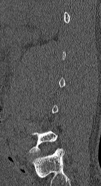 Burst fracture (Radiopaedia 53373-59357 Sagittal bone window 71).jpg