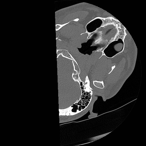 C1-C2 "subluxation" - normal cervical anatomy at maximum head rotation (Radiopaedia 42483-45607 Axial non-contrast 71).jpg