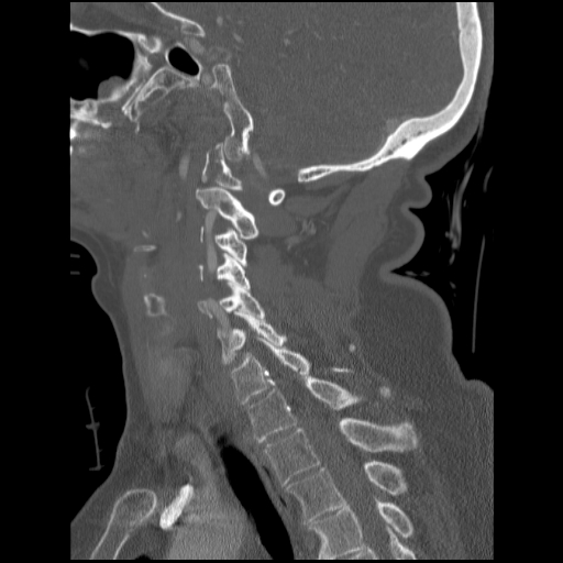 File:C1 anterior arch (plough) fracture - type 1 (Radiopaedia 76181-87720 Sagittal bone window 49).jpg