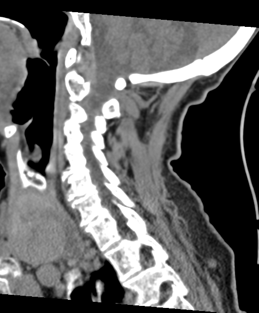 C2 fracture with vertebral artery dissection (Radiopaedia 37378-39199 D 46).png