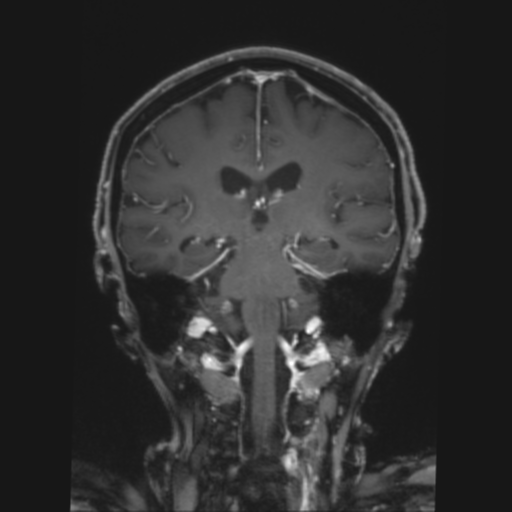 CNS lymphoma with steroid response (Radiopaedia 37980-39921 Coronal T1 C+ 27).png