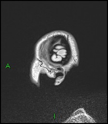 CNS manifestations of NF1 - optic pathway glioma, neurofibroma, dural ectasia (Radiopaedia 37874-39805 Sagittal FLAIR 137).jpg